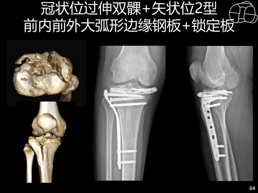 过伸型胫骨平台骨折