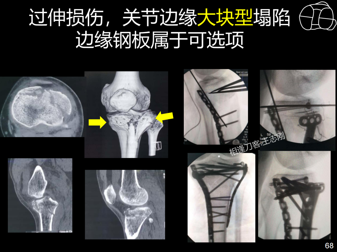 过伸型胫骨平台骨折