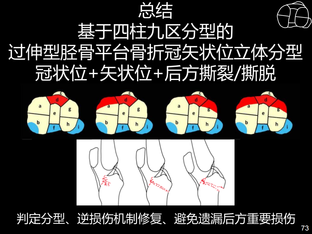 过伸型胫骨平台骨折