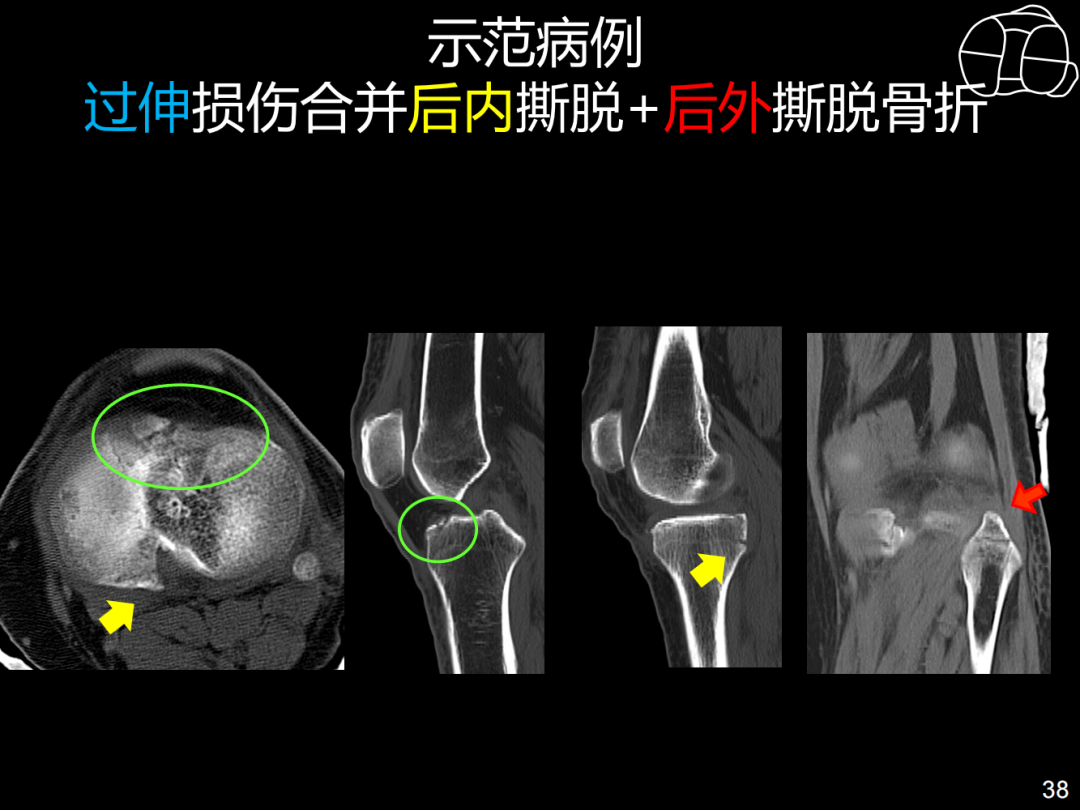 过伸型胫骨平台骨折