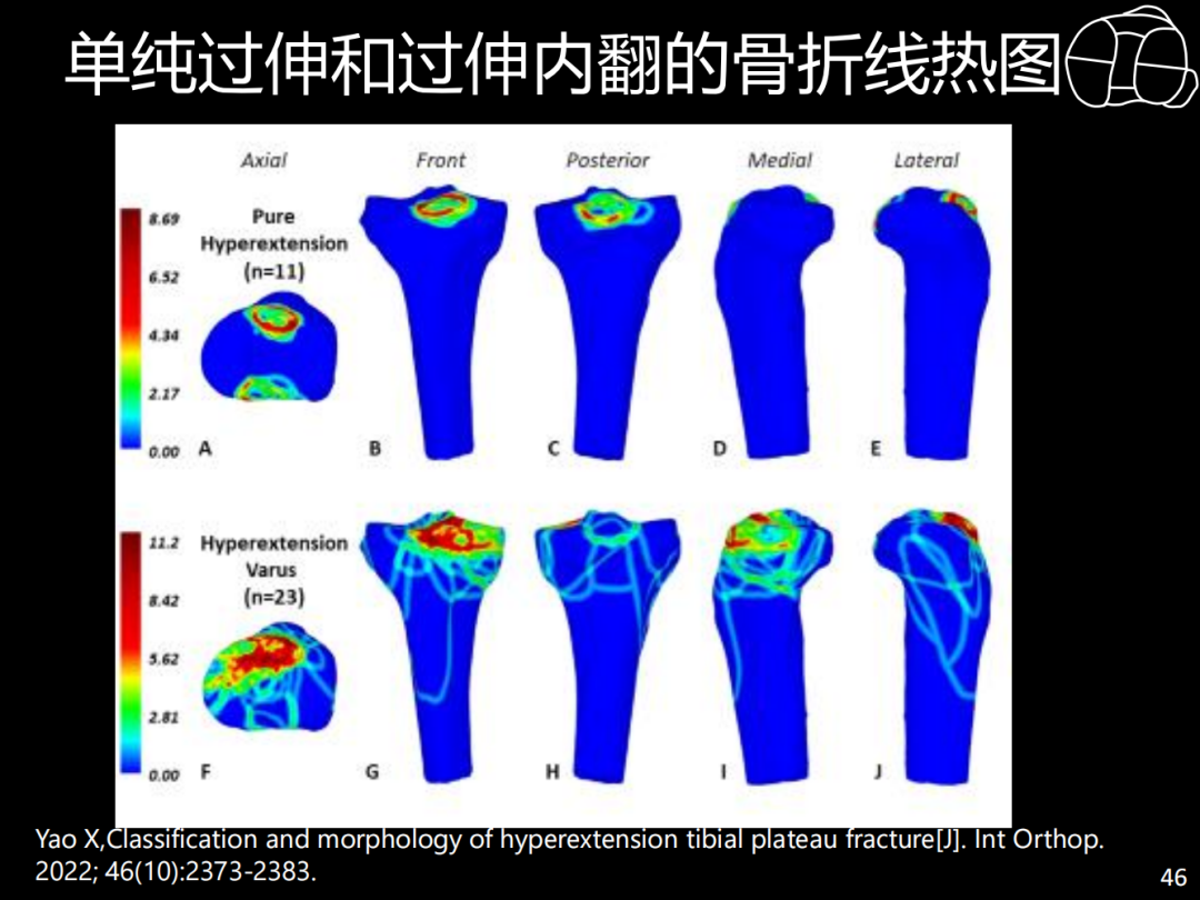 过伸型胫骨平台骨折