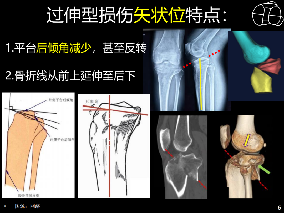 过伸型胫骨平台骨折