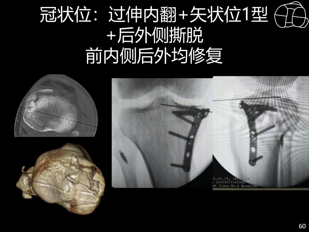 过伸型胫骨平台骨折