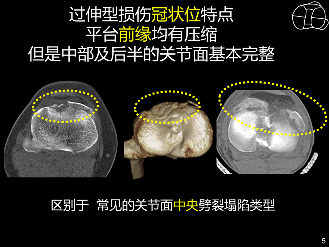 过伸型胫骨平台骨折