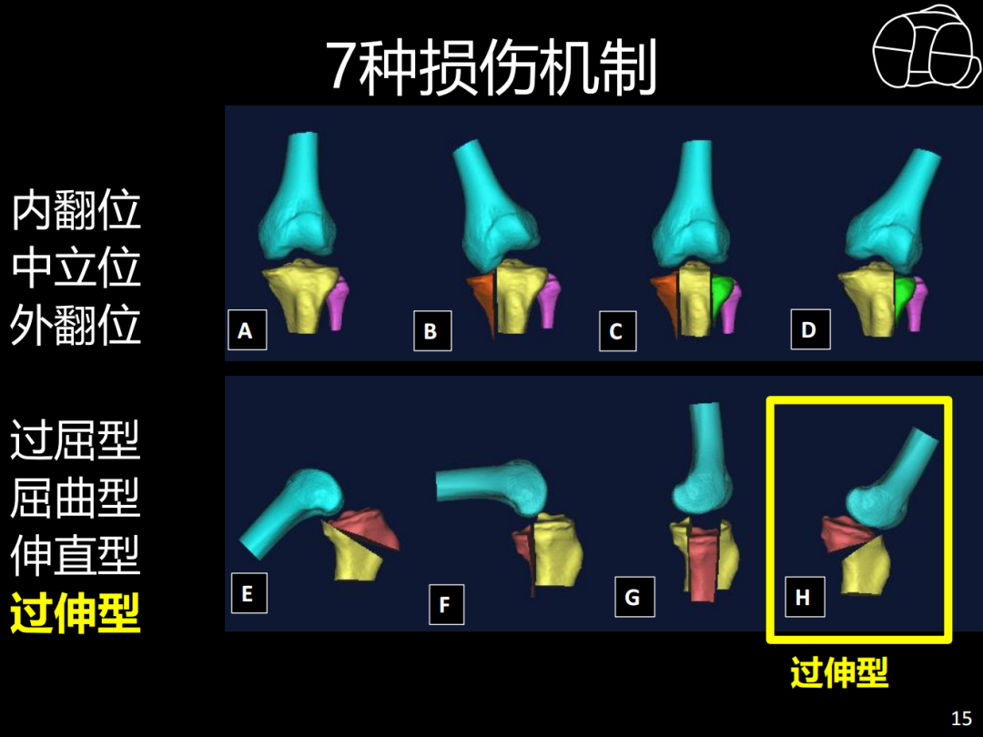 过伸型胫骨平台骨折