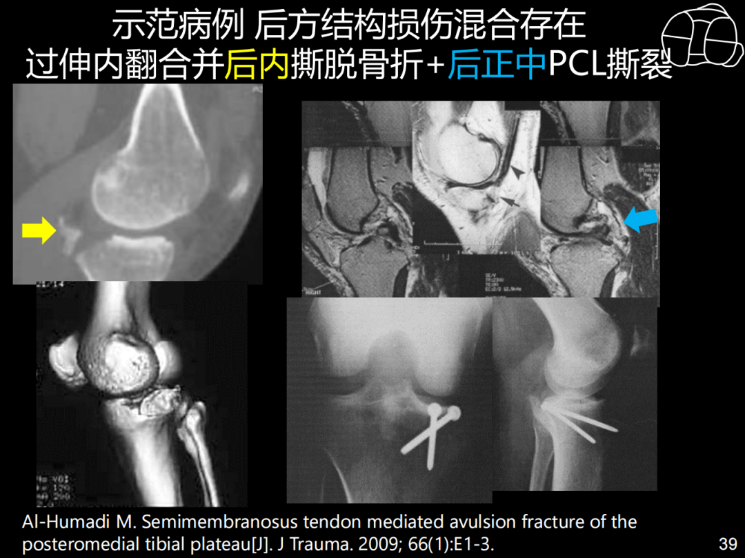 过伸型胫骨平台骨折