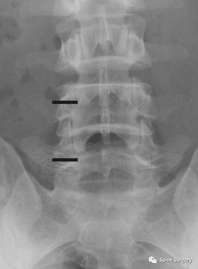 单侧双通道内镜下经椎间孔腰椎间融合技术（UBE-TLIF）