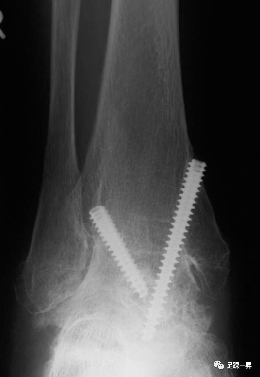 关节镜下踝关节融合技术之术中绷带牵引