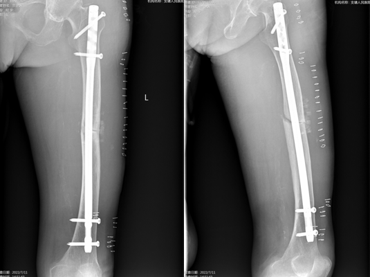 骨科医生最易忽视的股骨非典型骨折，附案例分析