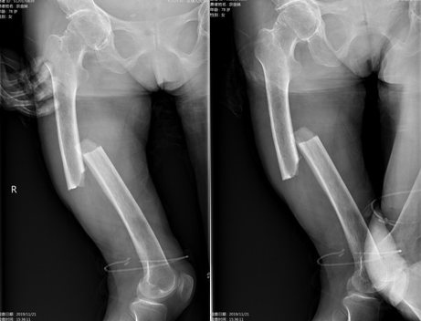 骨科医生最易忽视的股骨非典型骨折，附案例分析