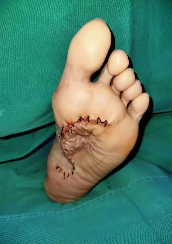 足部滑膜肉瘤显微外科治疗一例