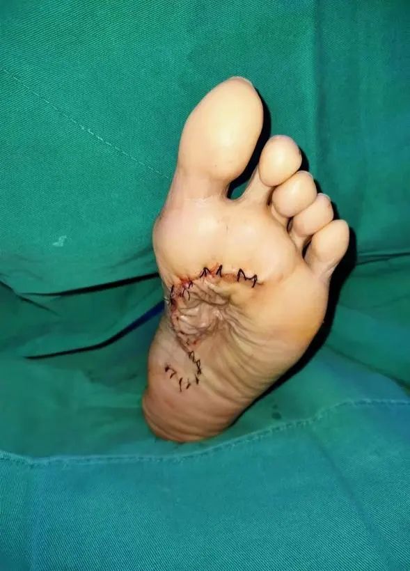 足部滑膜肉瘤显微外科治疗一例