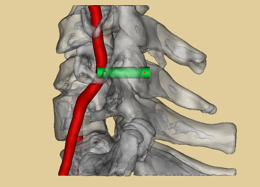下颈椎侧块螺钉内固定技术三维图谱