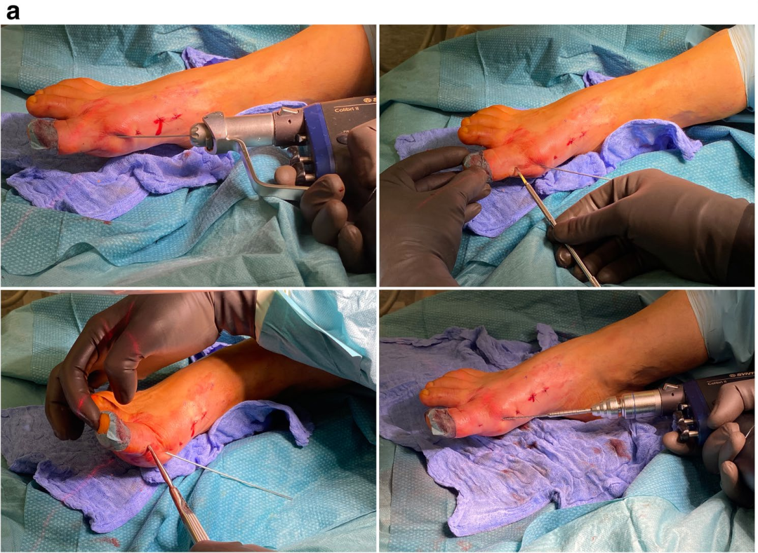手把手教你拇外翻矫形术：第3代MICA手术技术