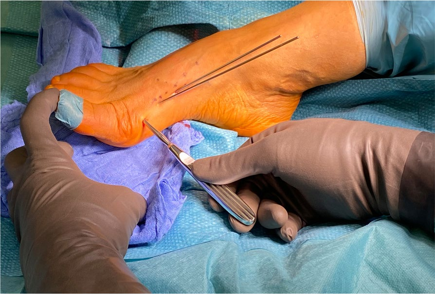 手把手教你拇外翻矫形术：第3代MICA手术技术