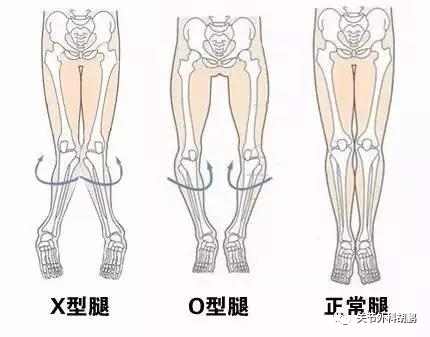 带你了解沉默的杀手——骨关节炎