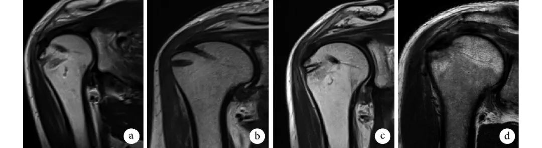 关节镜下单、双排缝合技术修复中型肩袖撕裂的早期疗效比较研究
