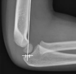 不稳定性儿童肱骨髁上骨折闭合复位内固定的5种手术技巧及相关注意事项