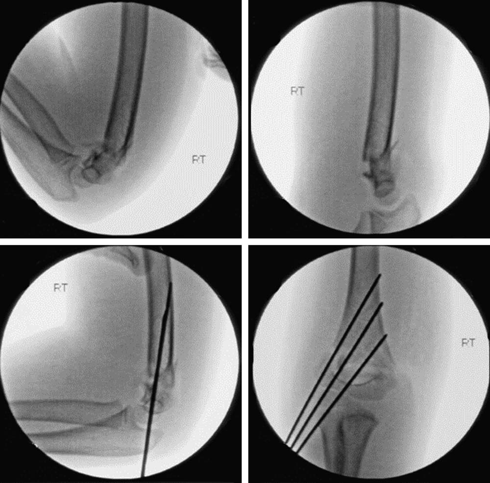 不稳定性儿童肱骨髁上骨折闭合复位内固定的5种手术技巧及相关注意事项