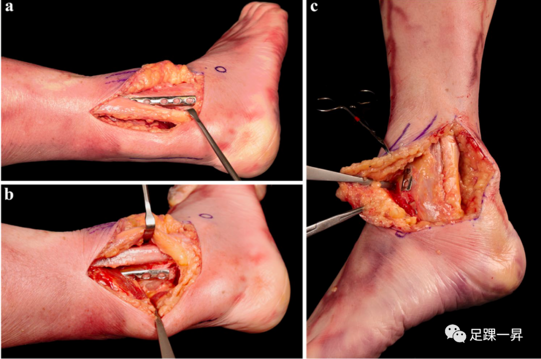 PAMELA入路：治疗复杂踝关节骨折的新入路（解剖篇）