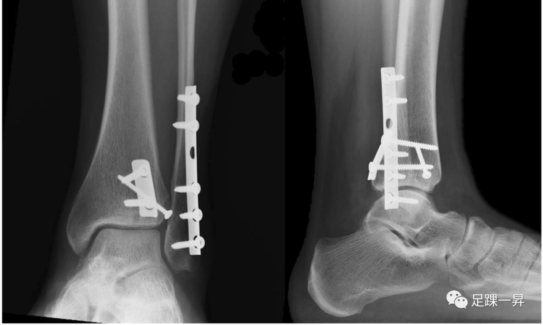 PAMELA入路：治疗复杂踝关节骨折的新入路（临床篇）