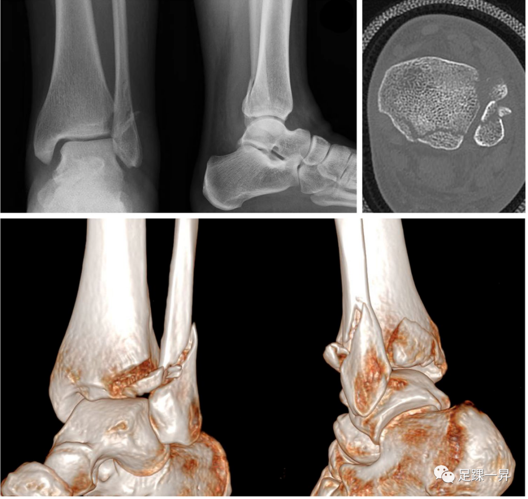 PAMELA入路：治疗复杂踝关节骨折的新入路（临床篇）