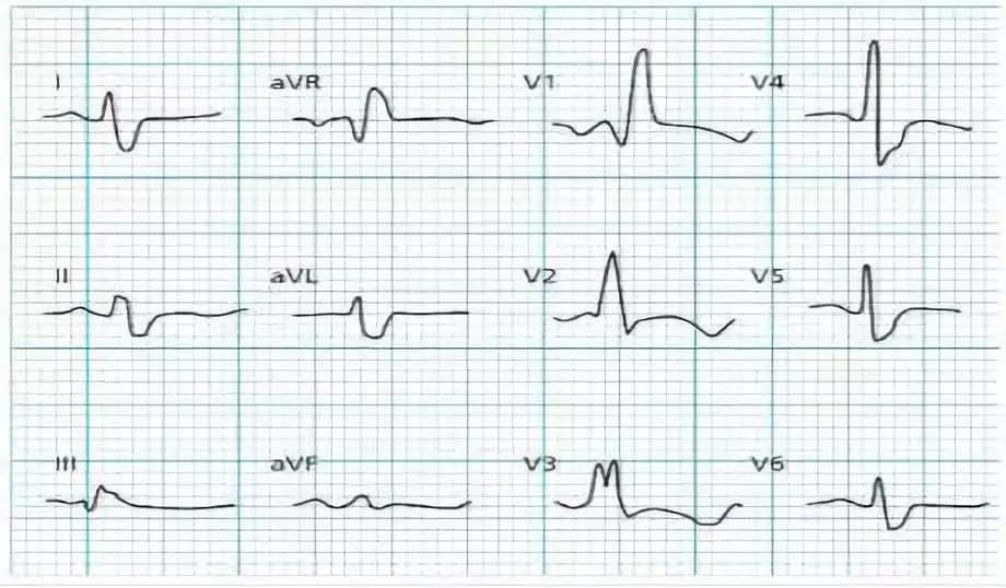 常见心肌病的心电图特征，一文掌握！