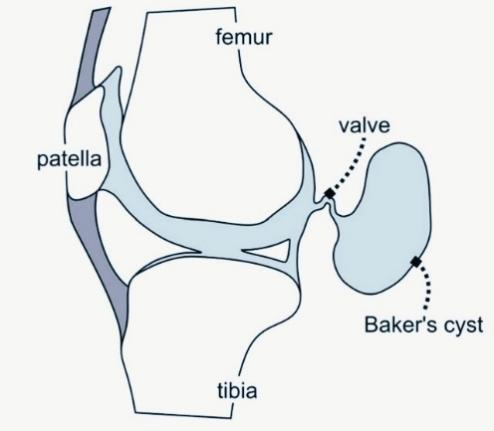 详解腘窝囊肿与膝关节镜下治疗