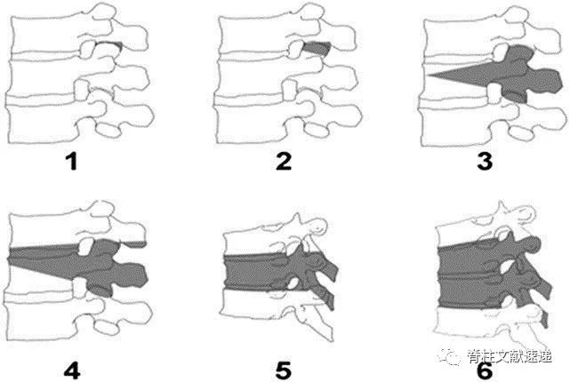 如何更好的理解脊柱截骨术？——脊柱6级截骨分类法