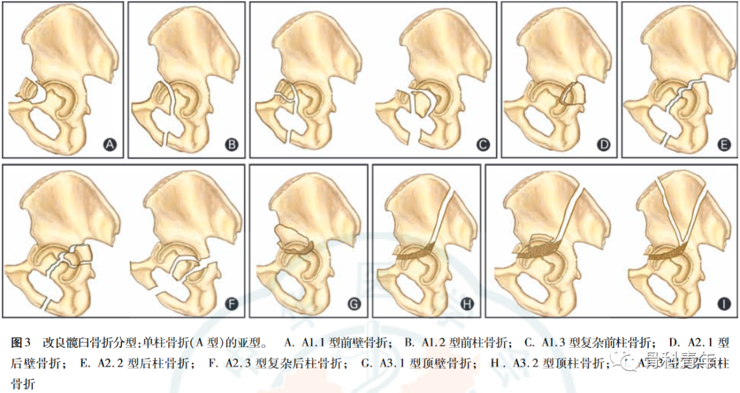 【骨科基础】介绍骨关节相关的7种“三柱理论”