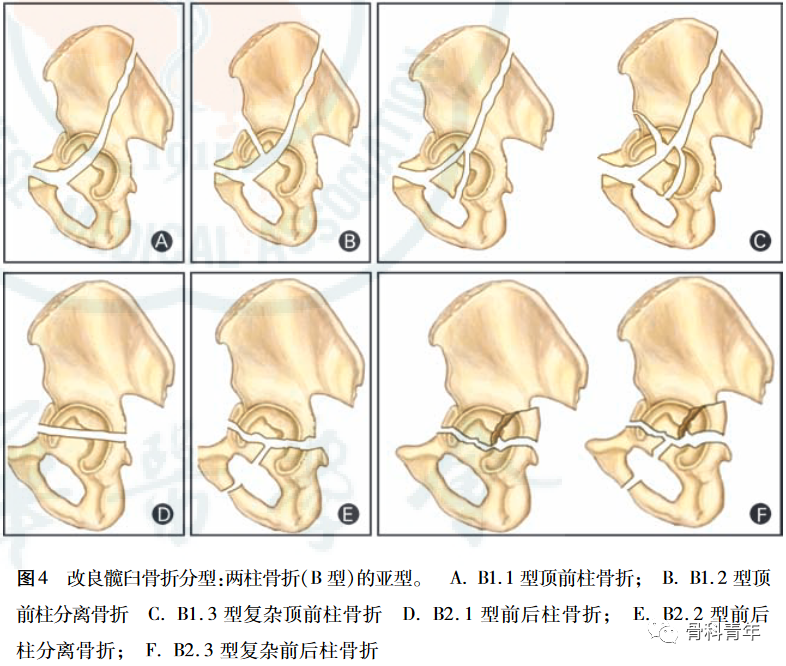 【骨科基础】介绍骨关节相关的7种“三柱理论”