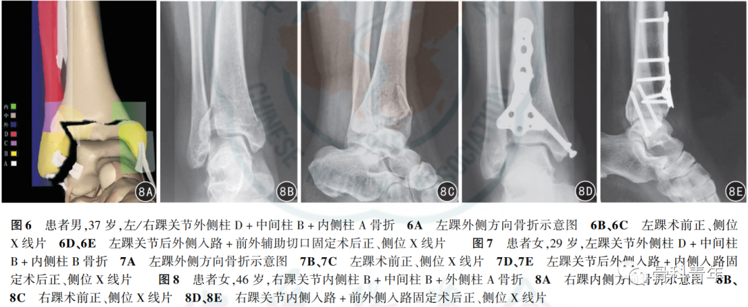 【骨科基础】介绍骨关节相关的7种“三柱理论”