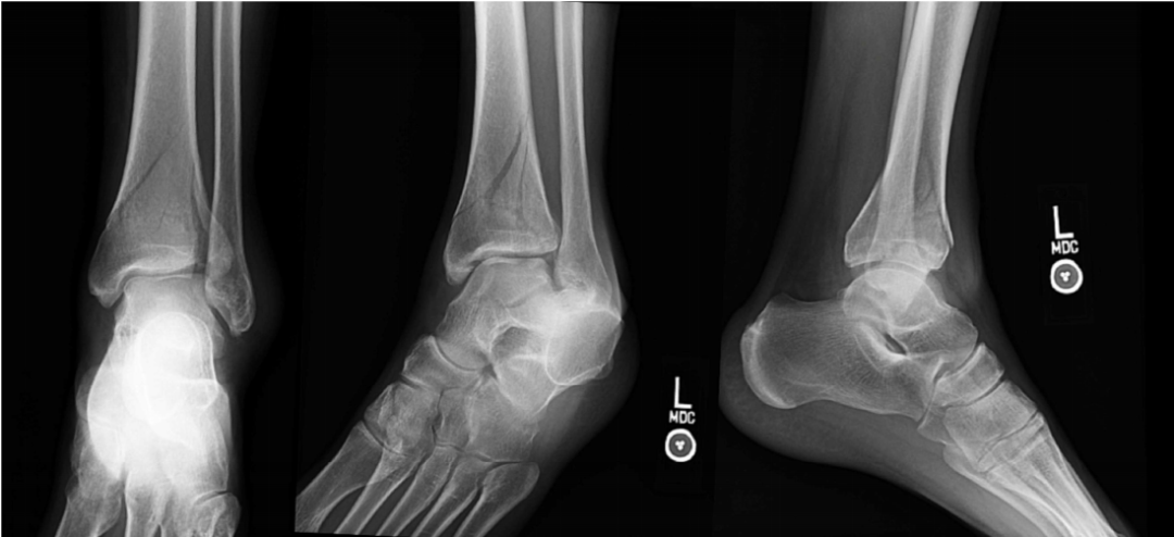 Pilon骨折合并胫骨后肌腱嵌顿的识别与手术技巧