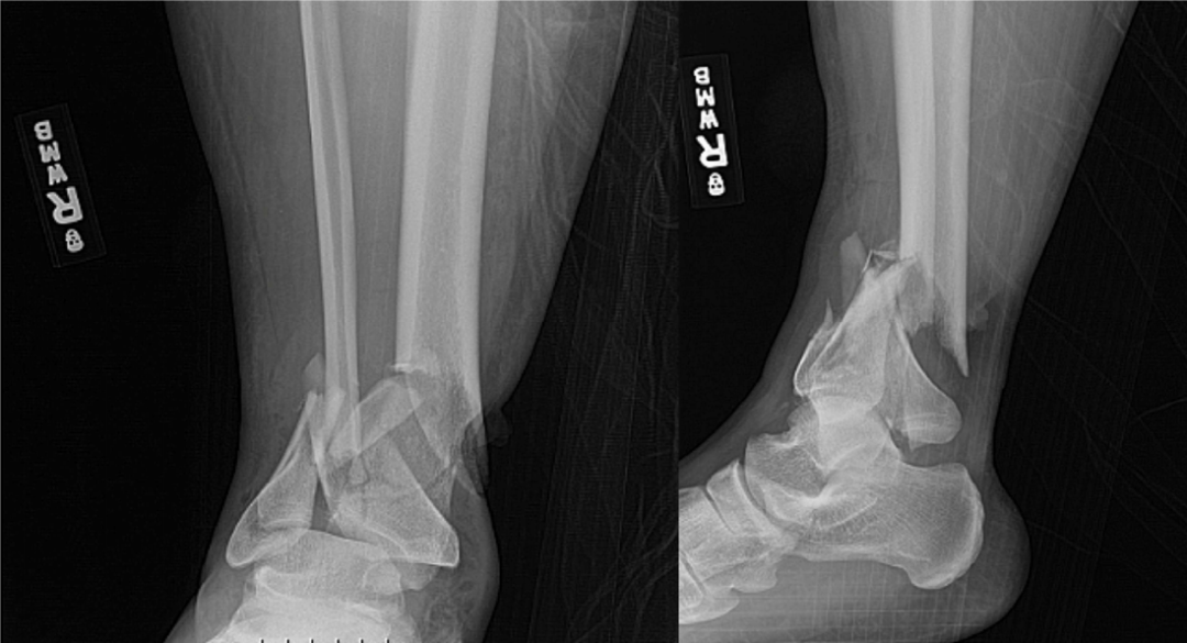 Pilon骨折合并胫骨后肌腱嵌顿的识别与手术技巧