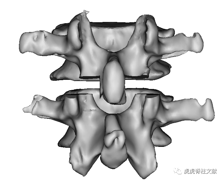 脊柱6级截骨三维图谱（Mimics