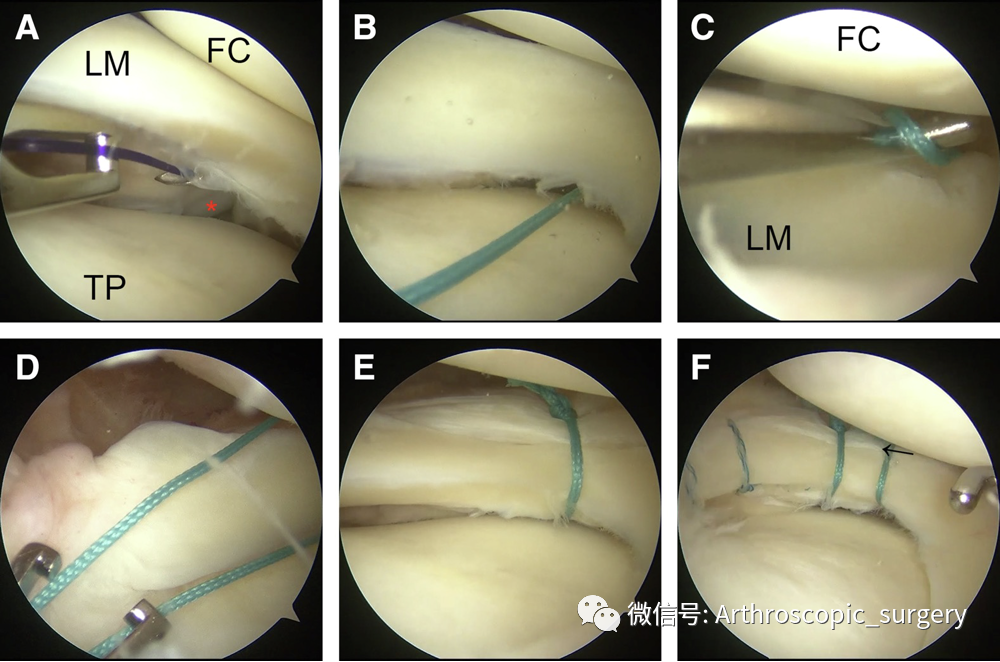 【手术技术】外侧半月板腘肌裂孔腱区损伤全内缝合技巧