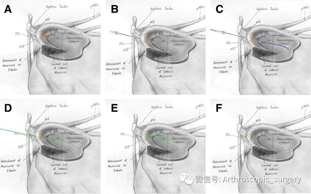 【手术技术】外侧半月板腘肌裂孔腱区损伤全内缝合技巧