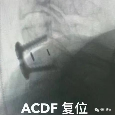 ACDF手术步骤GIF演示+病例展示