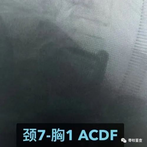 ACDF手术步骤GIF演示+病例展示