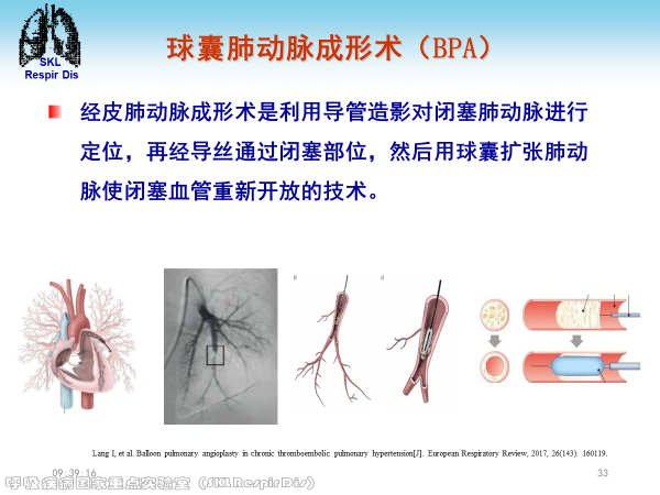 慢性血栓栓塞性肺动脉高压的诊治