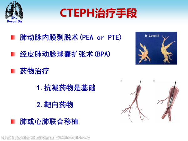 慢性血栓栓塞性肺动脉高压的诊治