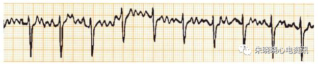 容易误诊的心律失常心电图实例分析