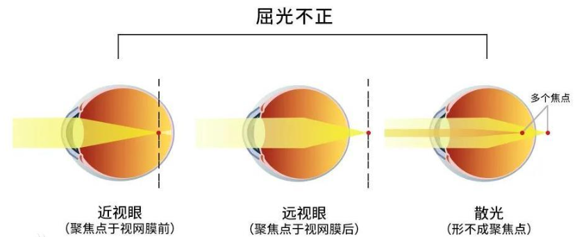 视力报告到底该怎么看？