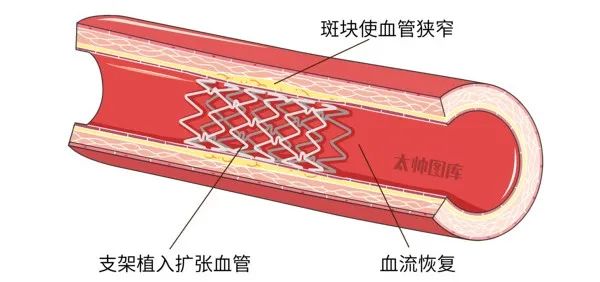 心脏支架10大谣言！