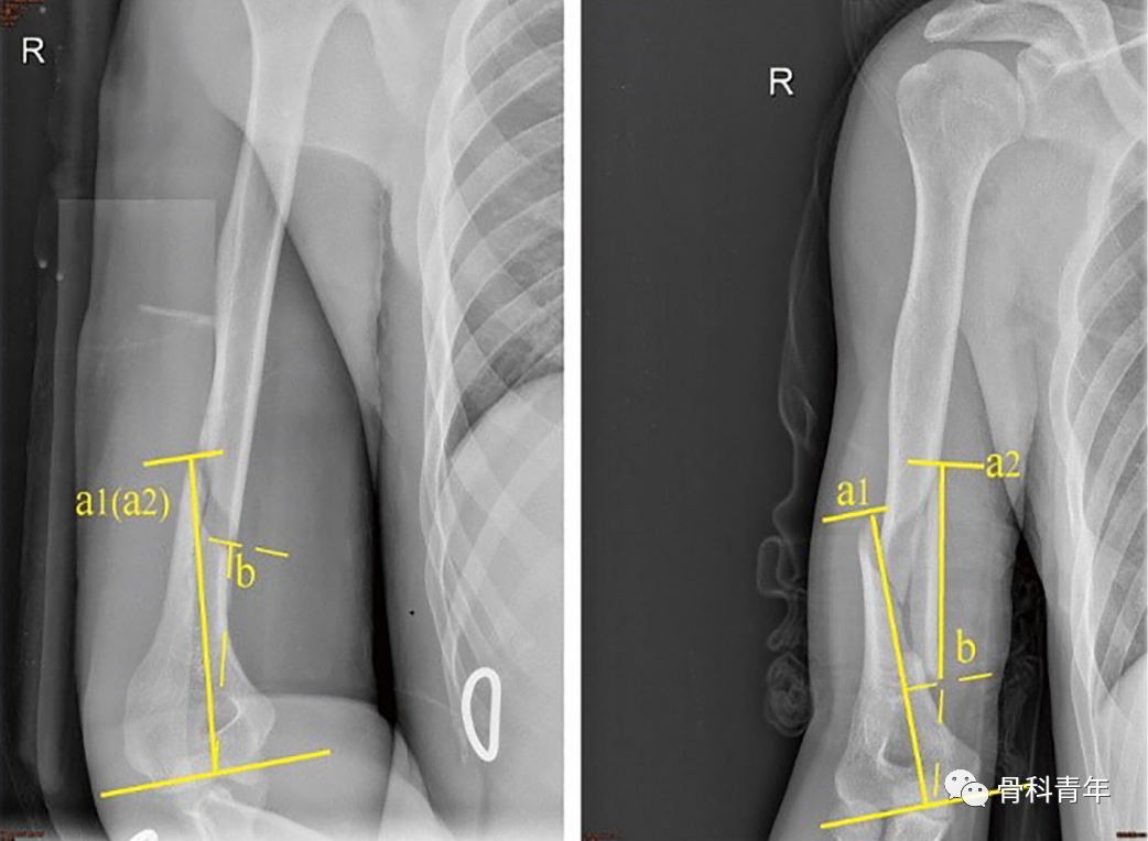 “掰手腕”如何导致肱骨干骨折？——损伤机制及临床特点分析