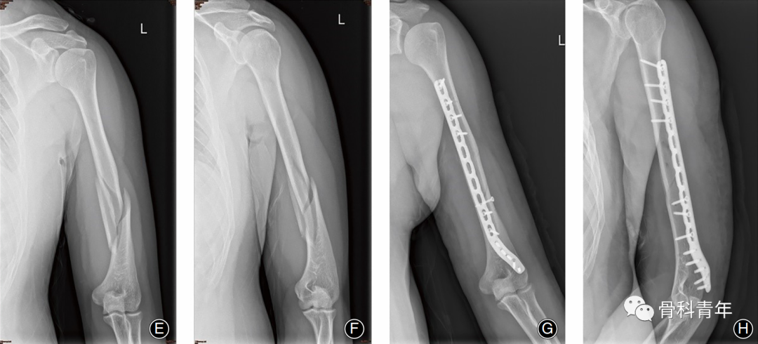 “掰手腕”如何导致肱骨干骨折？——损伤机制及临床特点分析