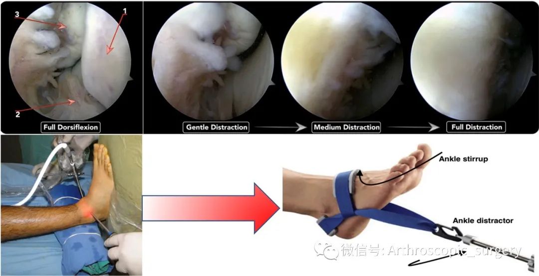 【手术技巧】踝关节镜下如何有效显露相应解剖结构