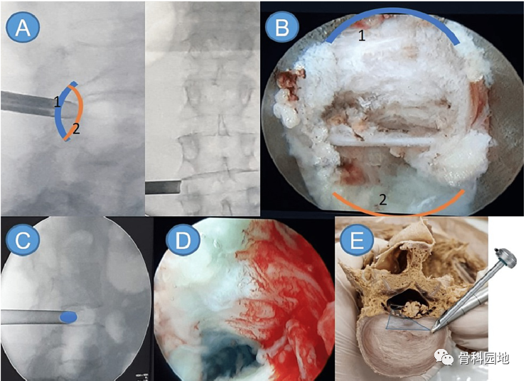 【手术技巧】辨认单通道脊柱内镜镜下解剖关系的新方法---“手法则”