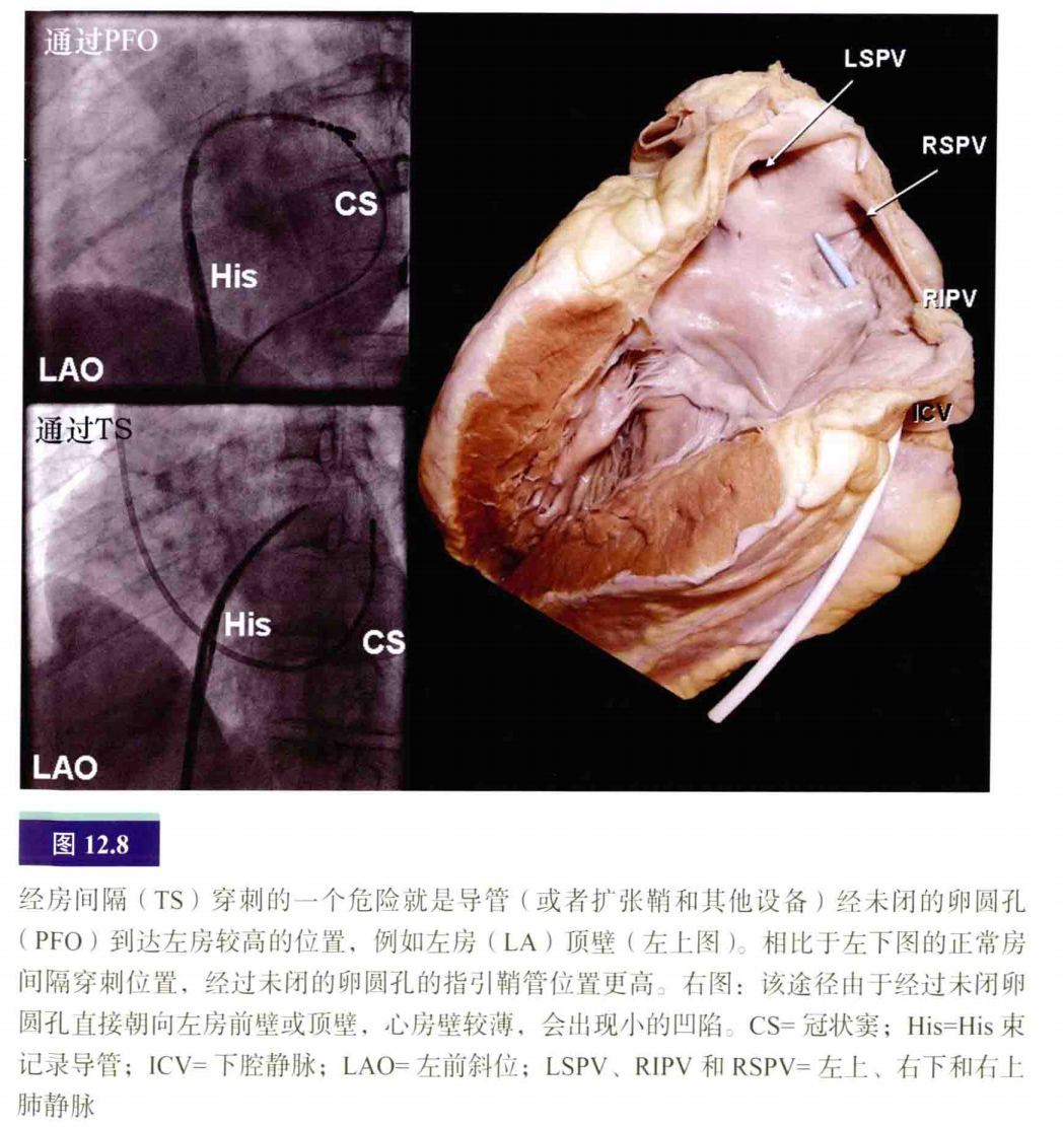 心脏解剖——导管操作技巧