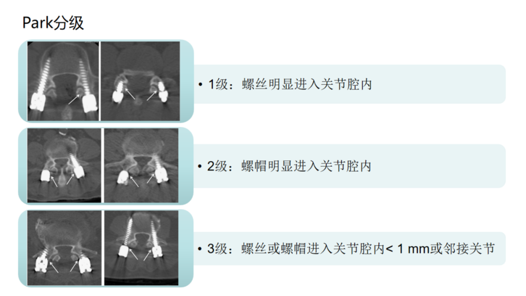 腰椎椎弓根螺钉损伤关节突关节的研究进展